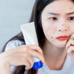 Comment traiter l’acné adulte de manière efficace